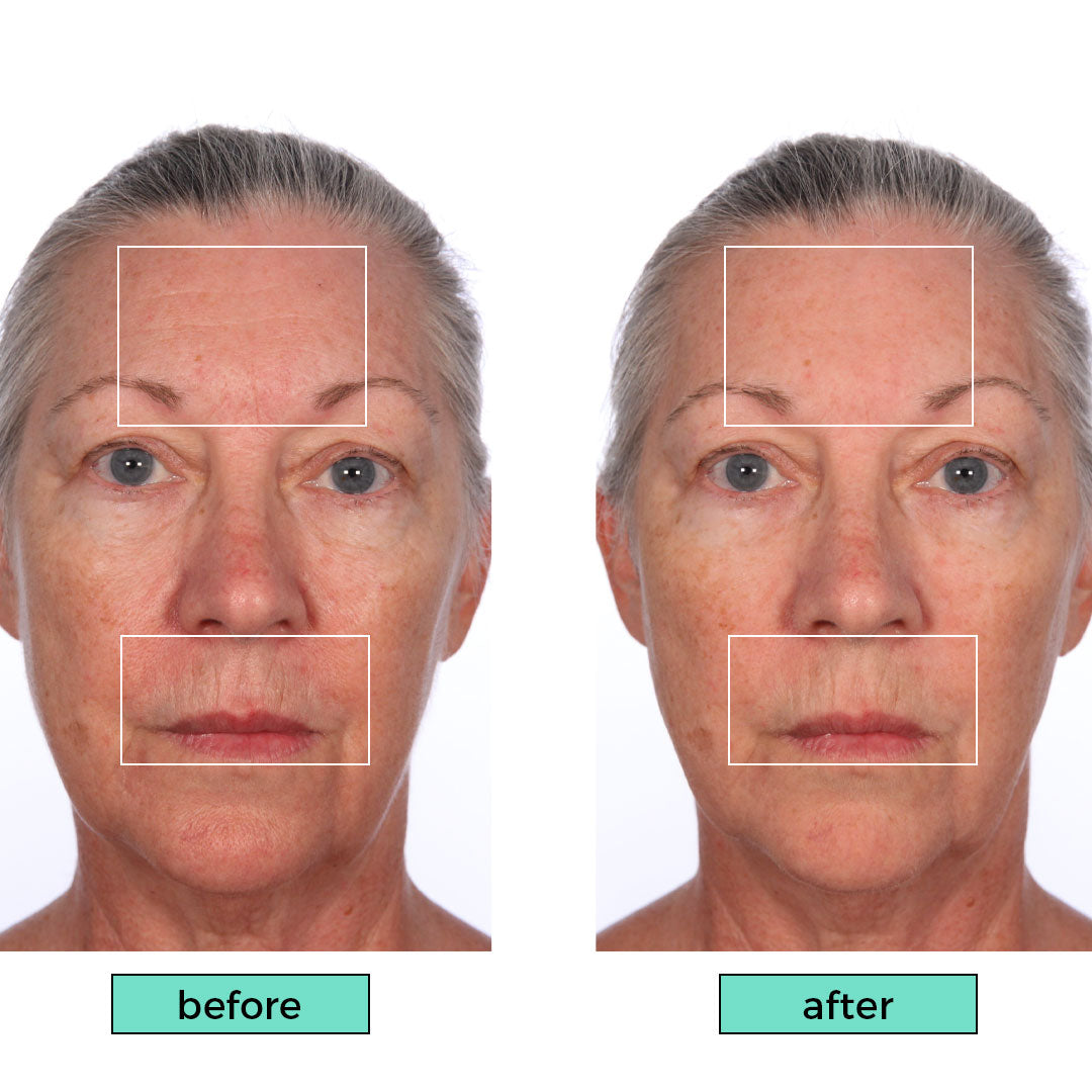 Ariul-10-Second-Filler-Peptide-Lifting-Cream-before-and-after