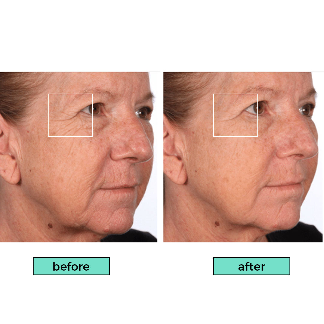 Ariul-10-Second-Filler-Peptide-Lifting-Cream-before-and-after