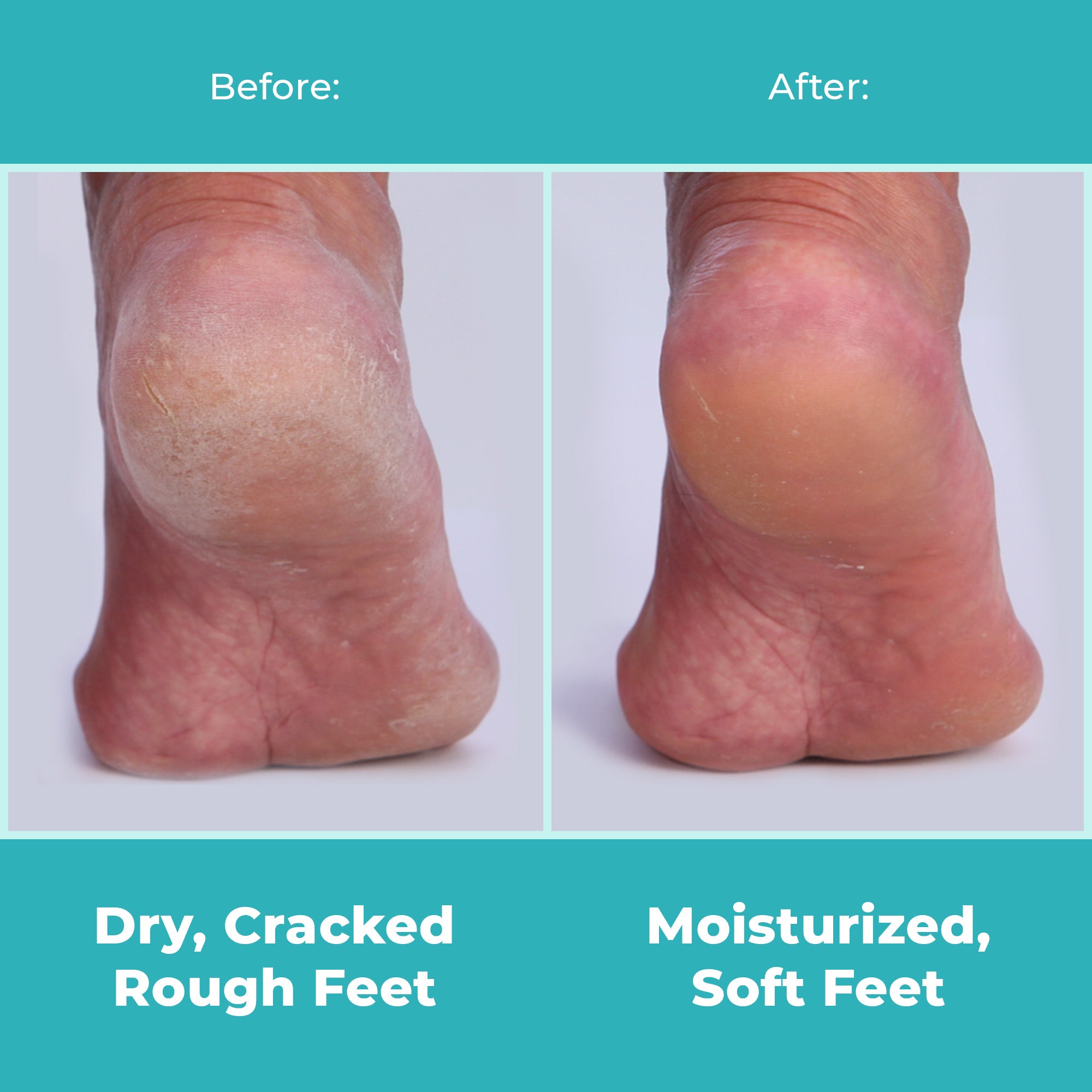 Why Are My Feet So Dry?, Natural Foot Peel